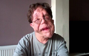 Adam Pearson: il lato oscuro della disabilità: Guida TV - TV Sorrisi e Canzoni